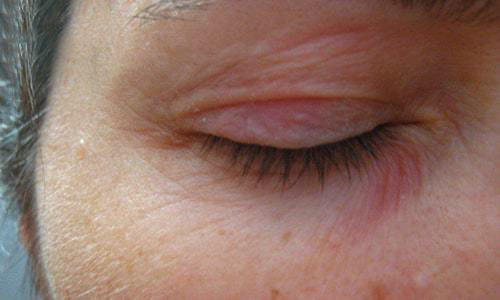 استفاده از کرم دور چشم به نوع پوست وابسته است